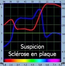 bioresonance suspicion sclerose