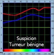 bioresonance suspicion tumeur